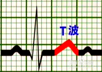 心电图各种波段解析