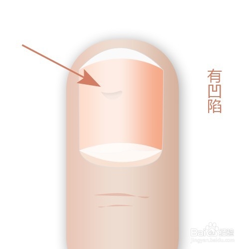 通过指甲看身体状况