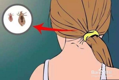 虱子卵怎么彻底去除 百度经验