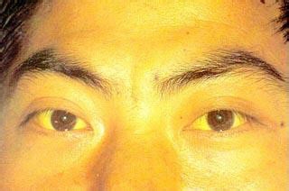 常见病辨别及处理：[1]胆石症