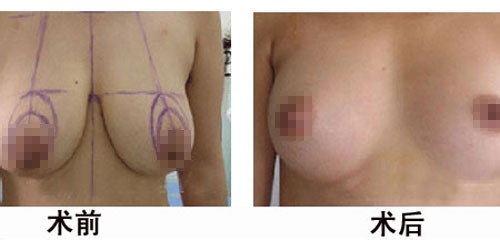 乳房下垂矫正