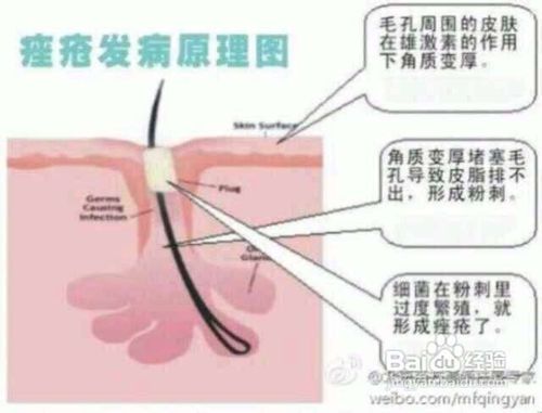 怎么快速去痘痘,养成良好的生活习惯