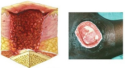 压疮的治疗方法