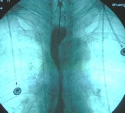 食道癌需要做哪些诊断