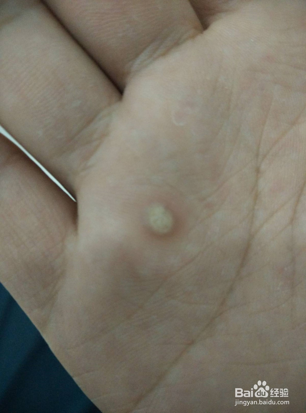 寻常疣治疗方法