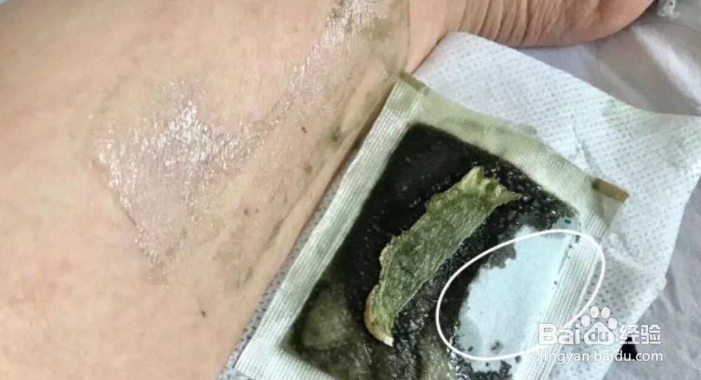 脚底贴中药贴真的有用吗
