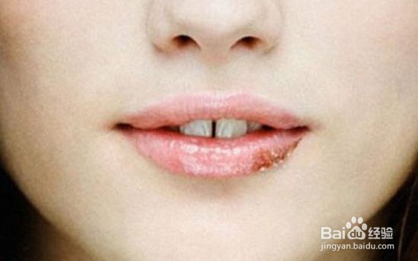 扁平苔藓症状哪些较常见