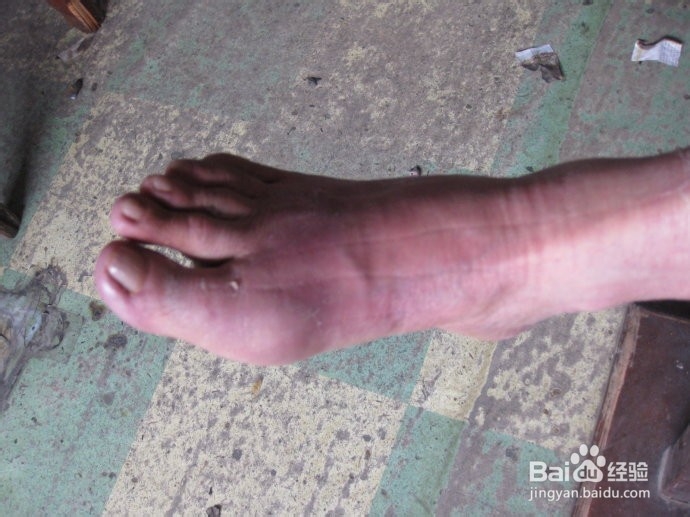 痛风病人需要注意些什么