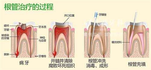 什么是牙隐裂？