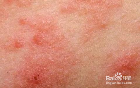 怎么判断人对狗过敏