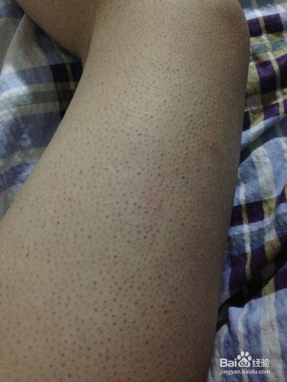 天生鸡皮肤图片，毛周角化症怎么治