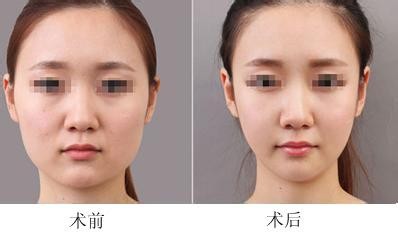 瘦脸常识（小知识）2