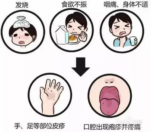 手足口病如何预防和应对
