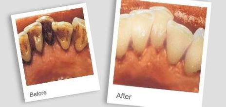 关于洗牙的那些事