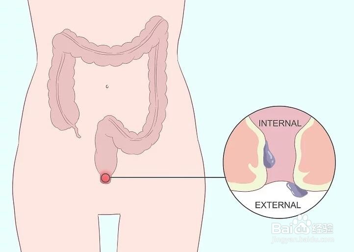怎样预防痔疮?