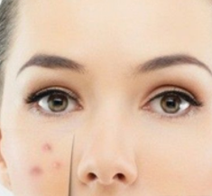 怎么祛痘痘最有效的方法