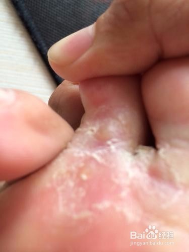 长期有脚气怎么办