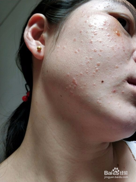 脸上长小疙瘩，可能是汗管瘤，也可能是这些疾病