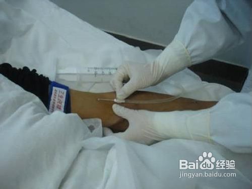 动脉穿刺操作的方法与步骤