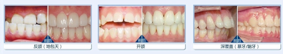 牙齿矫正的方法有哪些