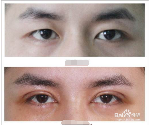 如何把双眼皮做得自然不露痕迹