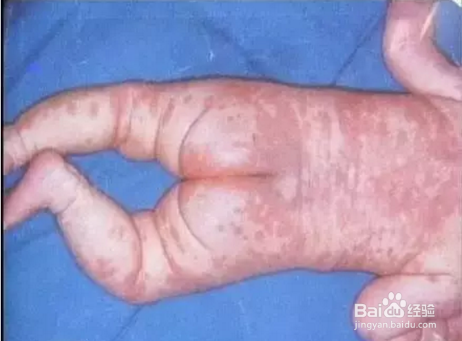 孩子湿疹，你为什么给他忌口？