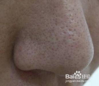 常挤黑头易出酒渣鼻,如何有效去除鼻周黑头