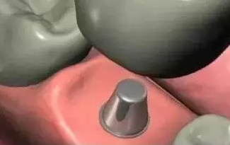 种植牙的过程是怎样的