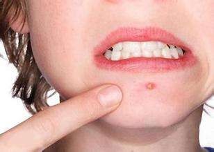 长痘痘的原因及调理方法