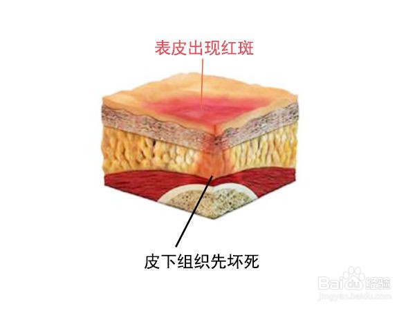 褥疮最早初期图片