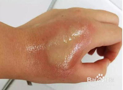 核桃树上虫子蛰了怎么办