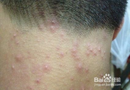 脖子湿疹出水怎么处理 百度经验