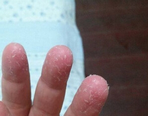 小孩手指脱皮是怎么回事？最近突然发现的不疼
