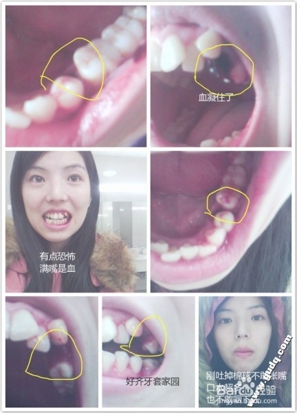 拔牙的过程和拔牙后的护理
