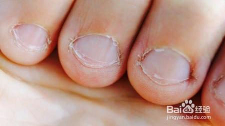 你喜欢咬指甲吗？咬指甲不加重视，或发展为强迫症