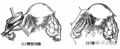 顺卵汤怎么治疗排卵障碍的