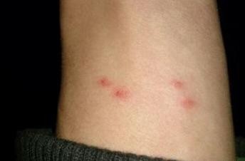 冬天皮肤干燥怎么办