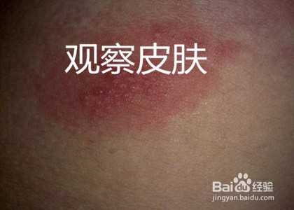 被猫身上的虫子咬了怎么办