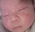 婴幼儿常见问题