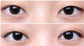 韩式开眼角整形不会留下痕迹吧