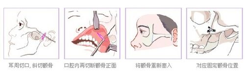 什么是颧弓颧骨整形