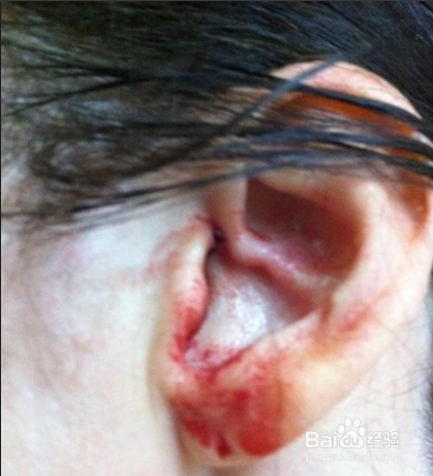 耵聍对生活的影响及如何正确挖取耵聍