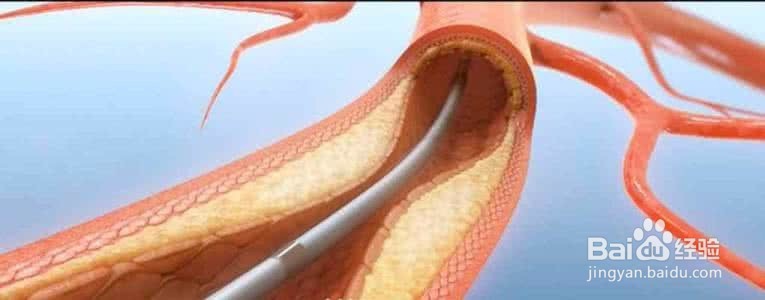 血管堵, 疾病生! 疏通血管就用这5招