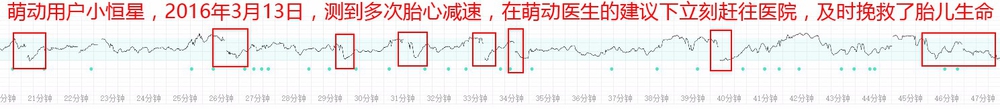 怎样及时发现胎儿缺氧