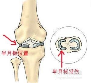 膝盖疼是怎么回事分情况护理膝关节