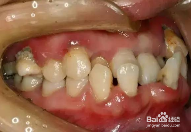 矫正牙齿的错误认识