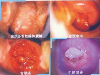 宫颈肥大是怎么回事