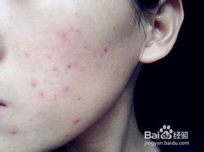 痘痘与肝脏的关系非同一般