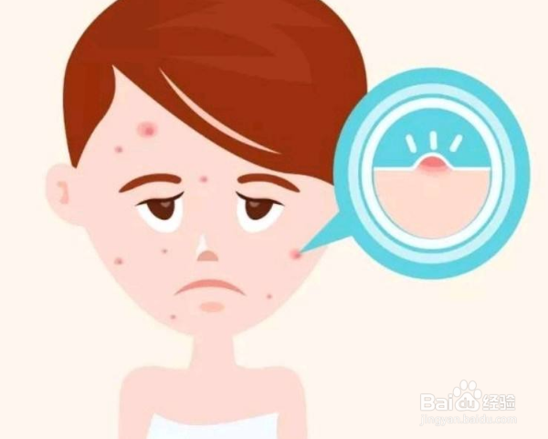 如何用天然的方法祛痘