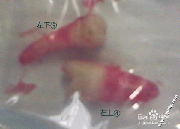 拔牙的过程和拔牙后的护理